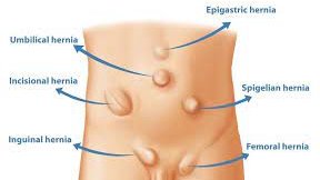 Ministry of Health and WHO offering free paediatric hernia repairs in Mutare